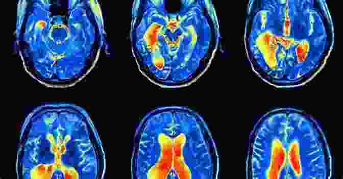 Magnetic Resonance Imaging (MRI) Scan Of A Brain Affected By Multiple Sclerosis Get Over Yourself: How I Reversed My Multiple Sclerosis